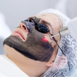 Hollywood Carbon Peel Laser