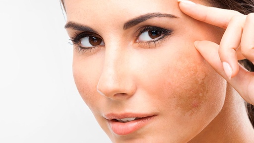 Melasma Treatment 